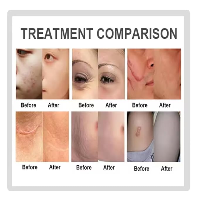Professional Fractional Skin Resurfacing System - 40W Medical Grade w/ 360° Tightening Heads & 7-Axis Arm for Scar Treatment & Rejuvenation (110V)