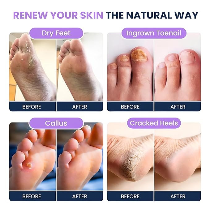Tea Tree Oil & Soothing Lavender Foot Soak with Epsom Salt - Best Toenail Treatment & Softens Calluses - Soothes Sore & Tired Feet, Foot Odor Scent, Spa Pedicure - Made in USA - 16oz (Pack of 2)
