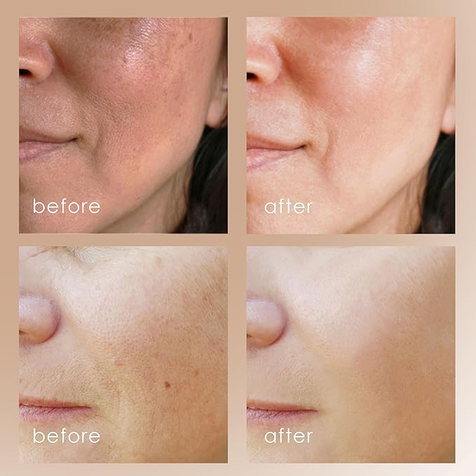 Reinvo Facial Microdermabrasion Wand by Project E Beauty | Gentle Exfoliation | Reduce Wrinkles & Fine Lines | Decrease Pores | Fresh & Radiant Skin | 4 Interchangeable Heads | Vacuum Suction Device