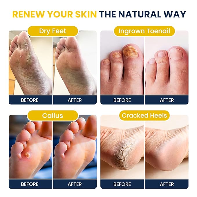 Citrus Detox Foot Soak With Epsom Salts - for Foot Callus, Immune Boost, Damaged Toenail, Athletes Foot, Pedicure and Soothes Tired Aching Feet - Made in USA 16 oz (Pack of 2)