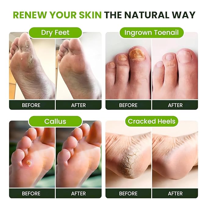 Tea Tree Oil Foot Soak with Epsom Salts- for Foot Pain, Soreness, Athletes Foot, Odors, Toe Nail Fungus, Fungal, Calluses Made in USA - 4 Pack