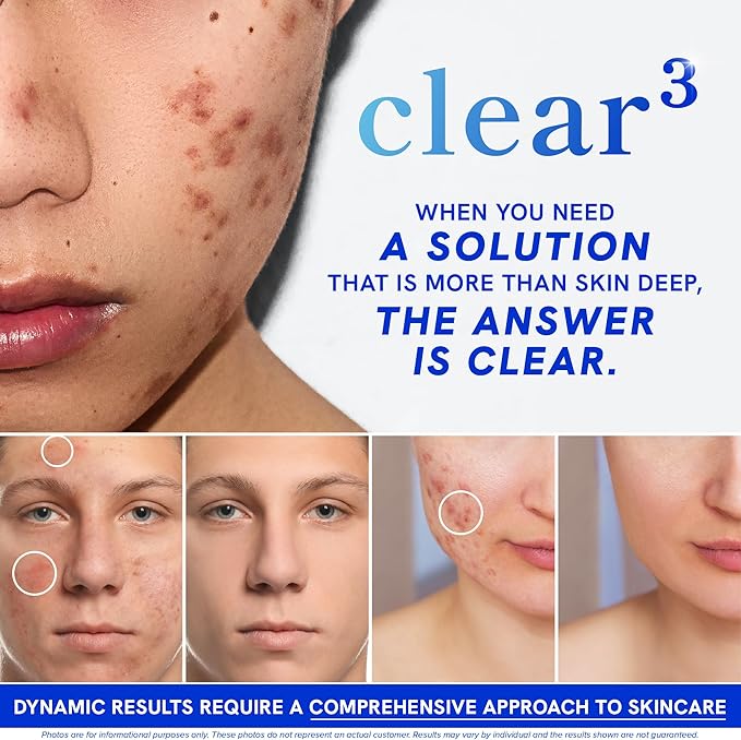 Clear Skin Acne Supplement with Zinc, DIM & Probiotics | 3-in-1 Balance, Clarify, Restore Support with Hyaluronic Acid & Skin Support Vitamins | for Women & Men | Oral Hormonal Acne Pills | 120 Ct