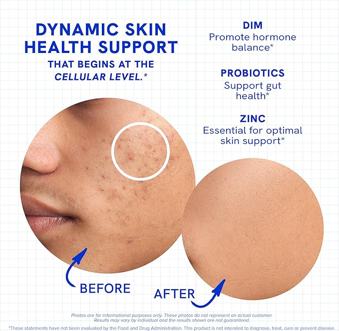Clear Skin Acne Supplement with Zinc, DIM & Probiotics | 3-in-1 Balance, Clarify, Restore Support with Hyaluronic Acid & Skin Support Vitamins | for Women & Men | Oral Hormonal Acne Pills | 180 Ct